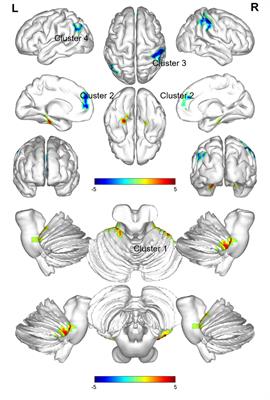 The abnormalities of brain function in females with primary insomnia: a resting-state functional magnetic resonance imaging study